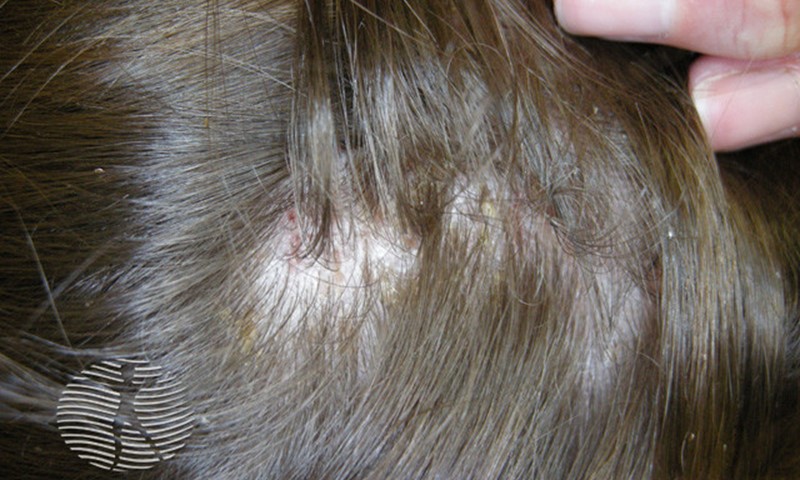 scalp when have lice