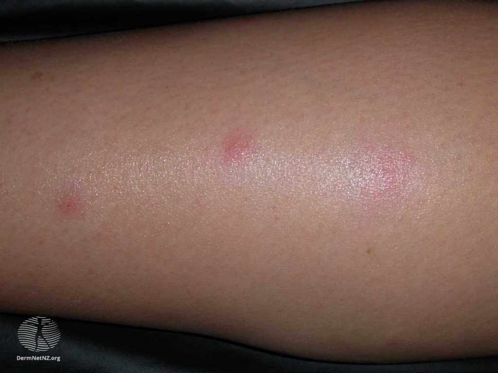 Insect bites & stings | NHS inform