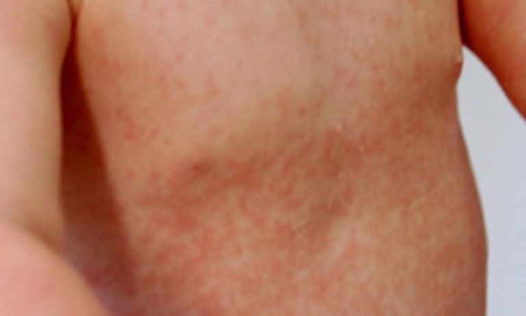 Rubella NHS inform Rubella NHS inform