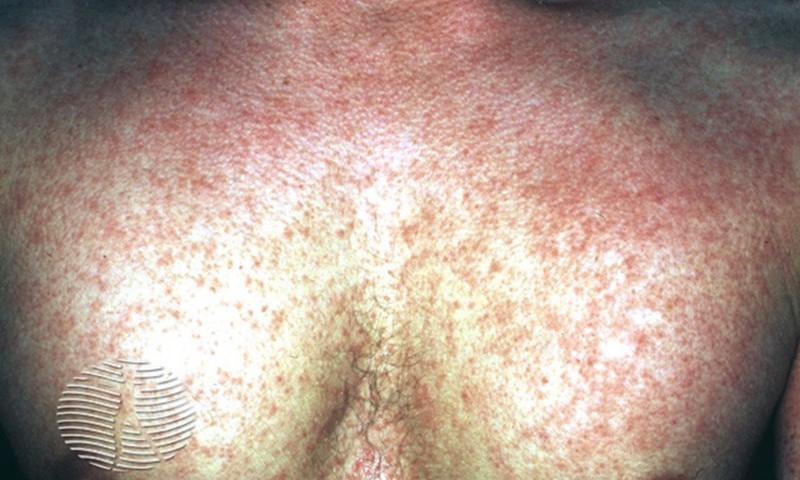 strep rash on chest