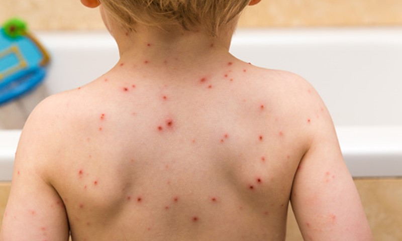 Chickenpox NHS Inform Chickenpox NHS Inform
