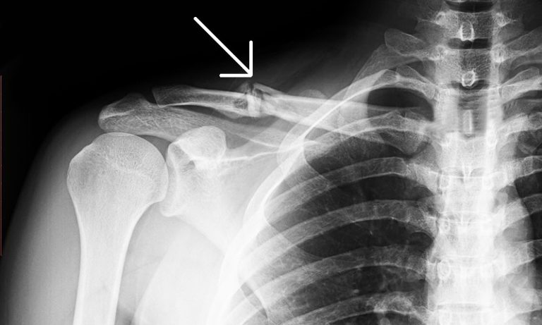 Clavicle (collar bone) fracture | NHS inform