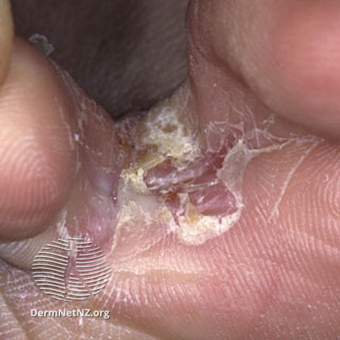 dry, flaking skin in between big toe and second toe