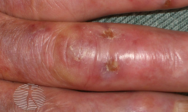 lupus pernio fingers