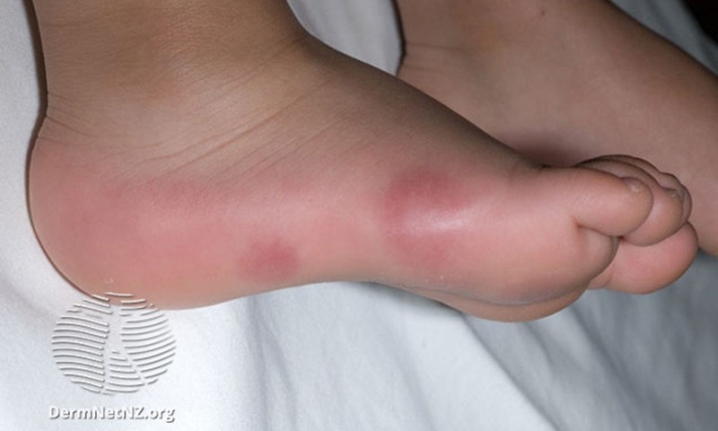 Do you have cold or swollen feet this winter?