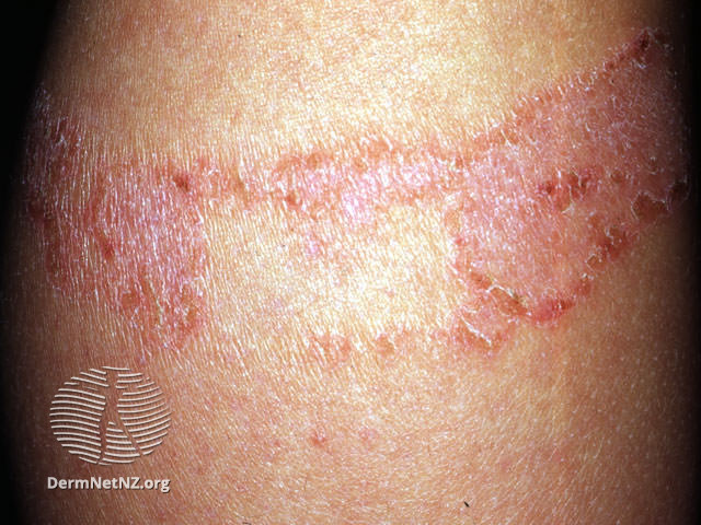 Patch of pink skin with a dark red outline