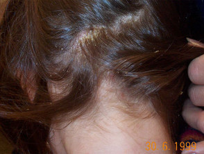 Person with dark, straight hair parted at the back. There are white flakes near the scalp.