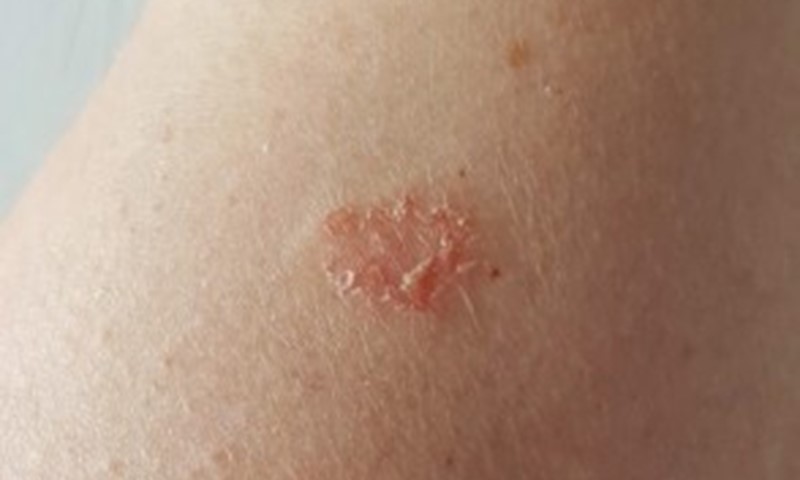 mild nummular eczema