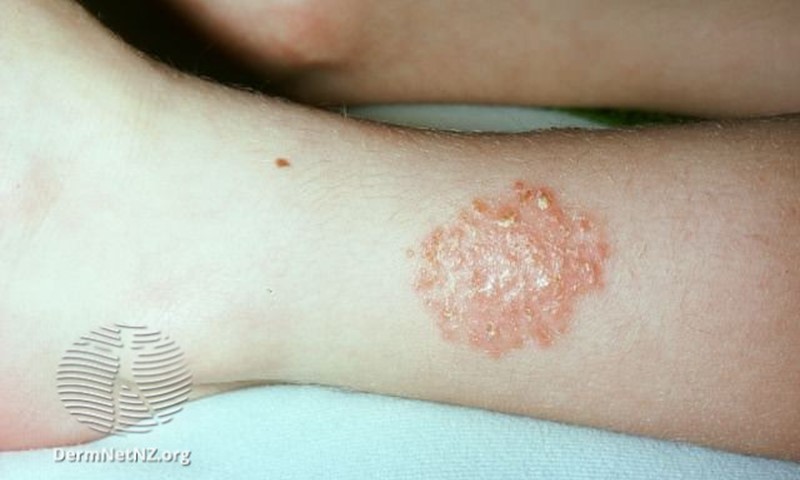 Discoid Eczema 4 
