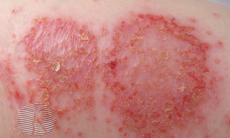 discoid eczema 5