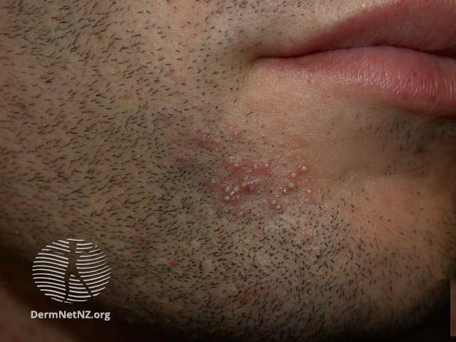 Cheek and lips of a man with short stubble. There are small, raised pink lumps in patches of the stubble. 