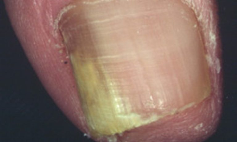 Fungal Nail Infection Nhs Inform