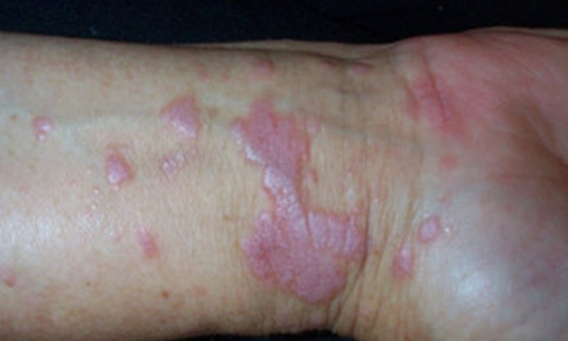 When should I see a dermatologist for a rash?