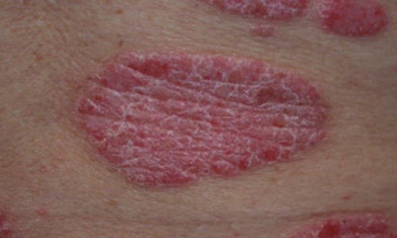 Plaque Psoriasis: Causes, Triggers, and Treatment: National Psoriasis  Foundation