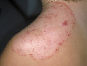 Shoulder with large circle outline of dark red, raised rash. The inside of the rash is pale with dark red spots. 