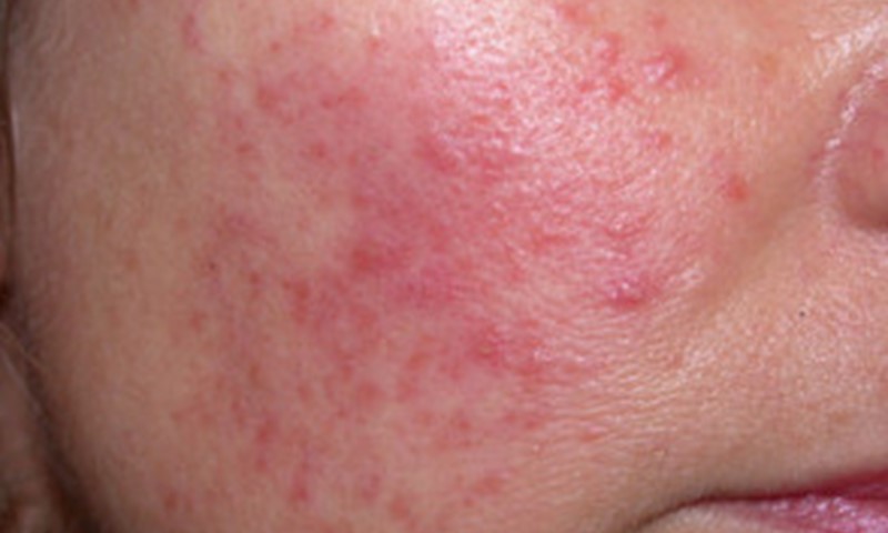 Red Spots Explained: Causes, Symptoms, And Treatments