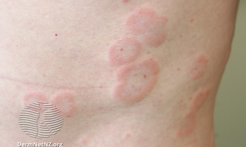 Red and itchy? When to worry about a rash in adults