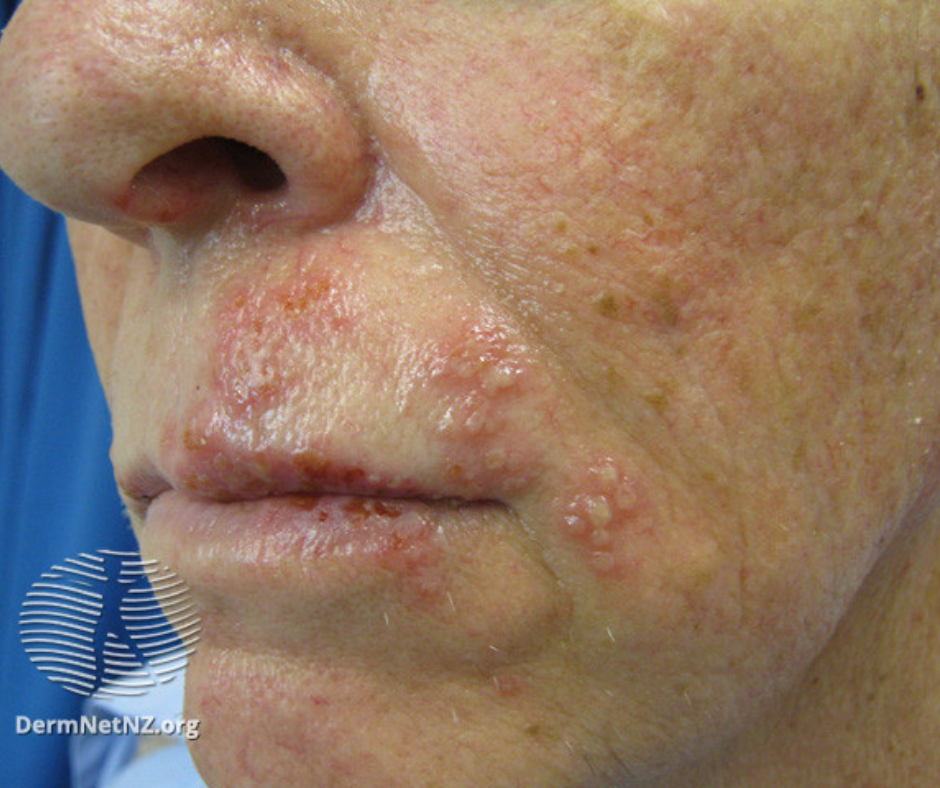 Shingles Symptoms Rash On Face