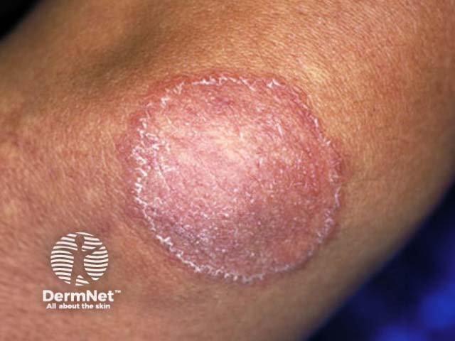 Circular rash on the arm that's dry, red and flaky.