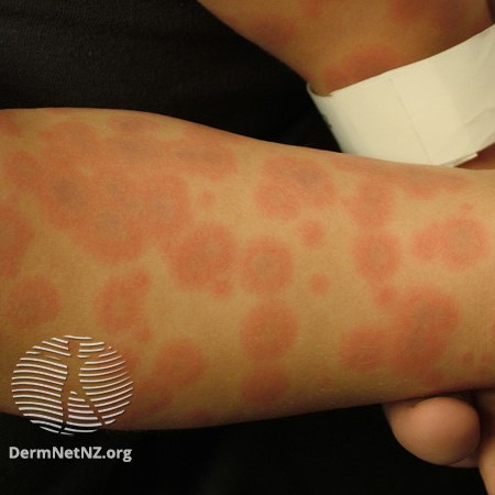 Eczema types: Atopic dermatitis symptoms