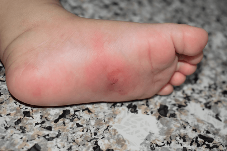 Skin rashes in children | NHS inform
