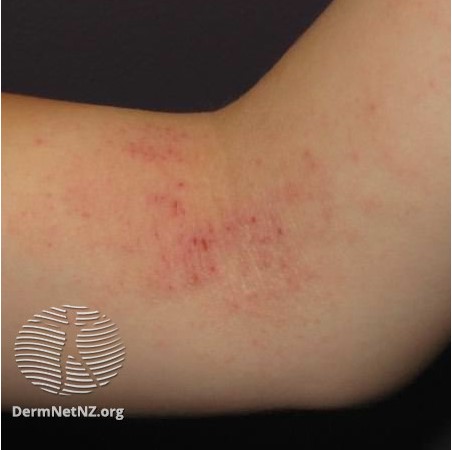 Common Childhood Skin Rashes With Pictures: What Rash Is This