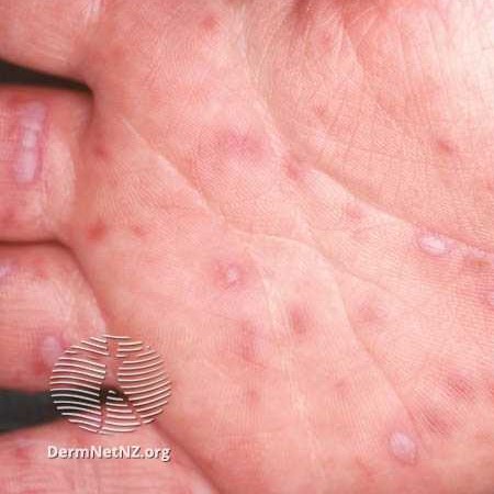 Skin rashes in children