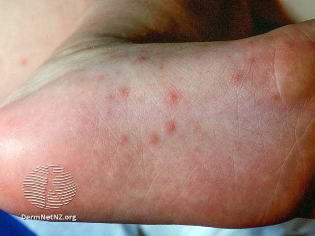 Genital Rash: Causes and How It's Treated