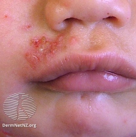 Rashes in babies and children - NHS