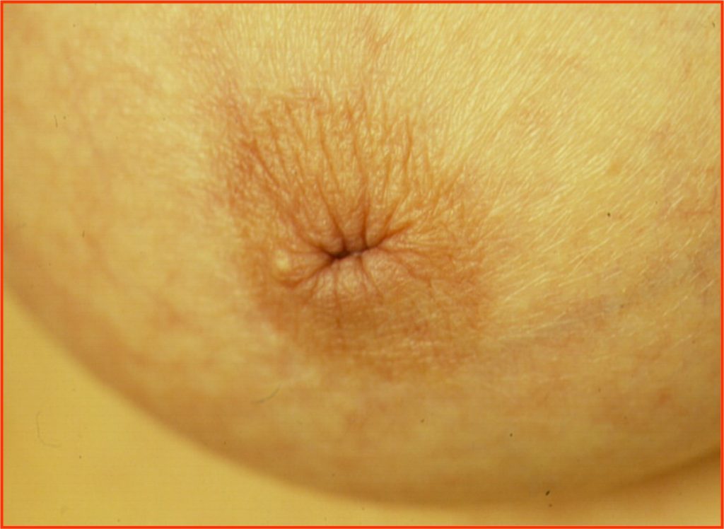 Nipple inversion (inside out nipple)
