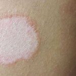 Skin rashes in children | NHS inform