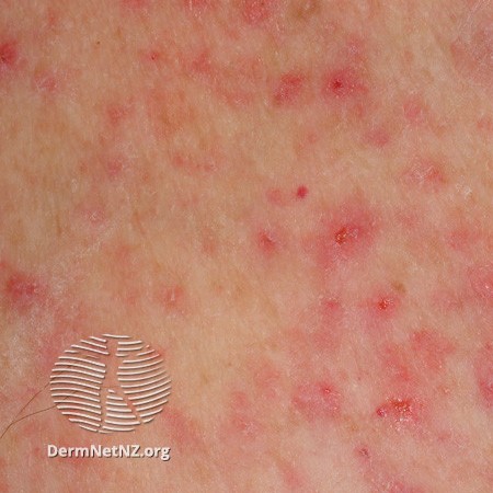 Non-itchy Rash between breasts (pic) - October 2015 Babies