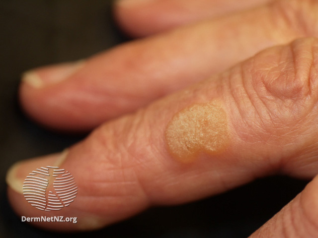 large raised lump of dry skin on finger