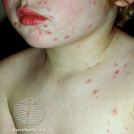Hives or urticaria in children & teenagers
