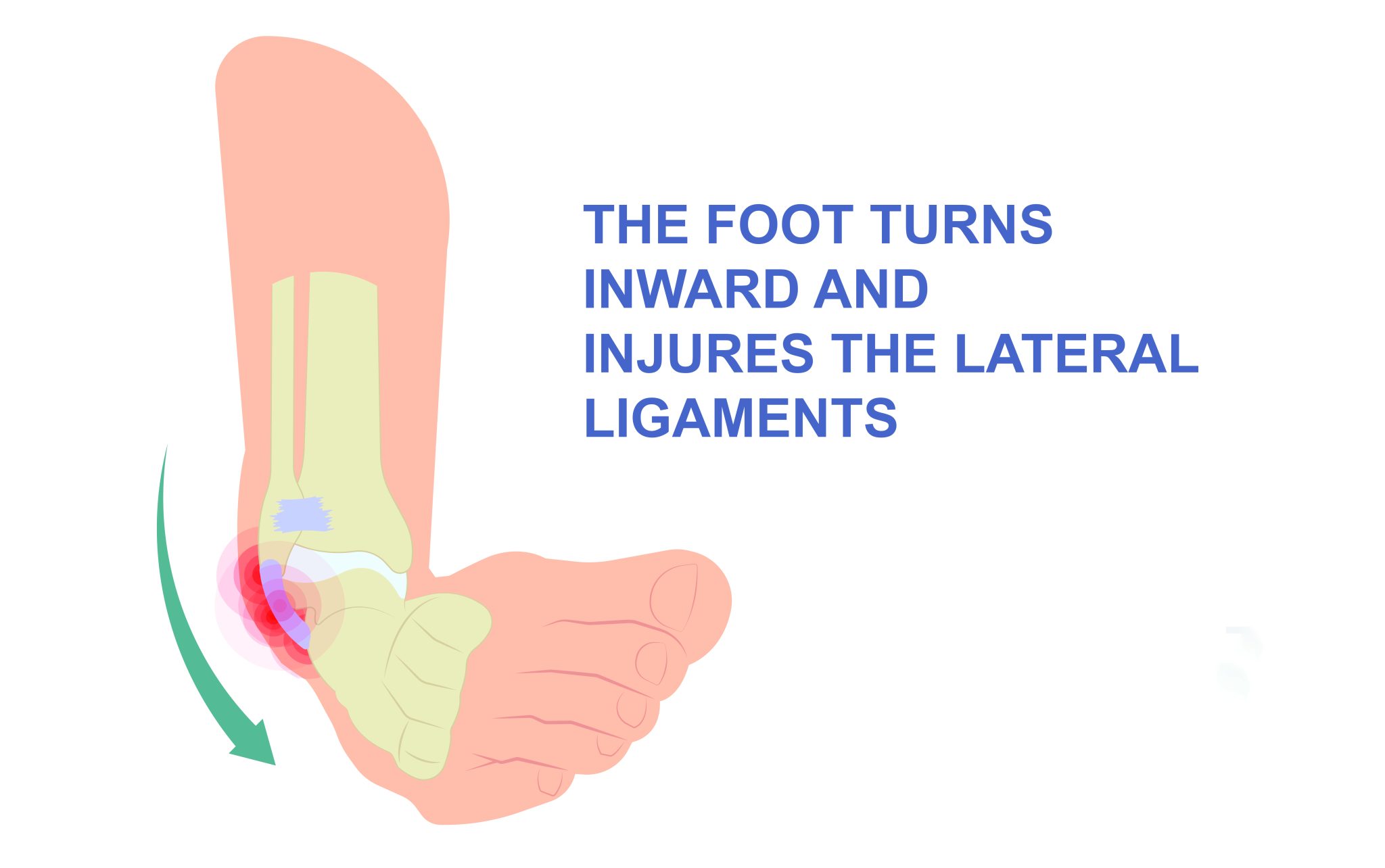 ankle-sprain-nhs-inform