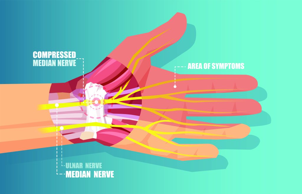 Diagram showing the location of the median nerves in the wrist and the common affected area (the index and middle fingers and the thumb).