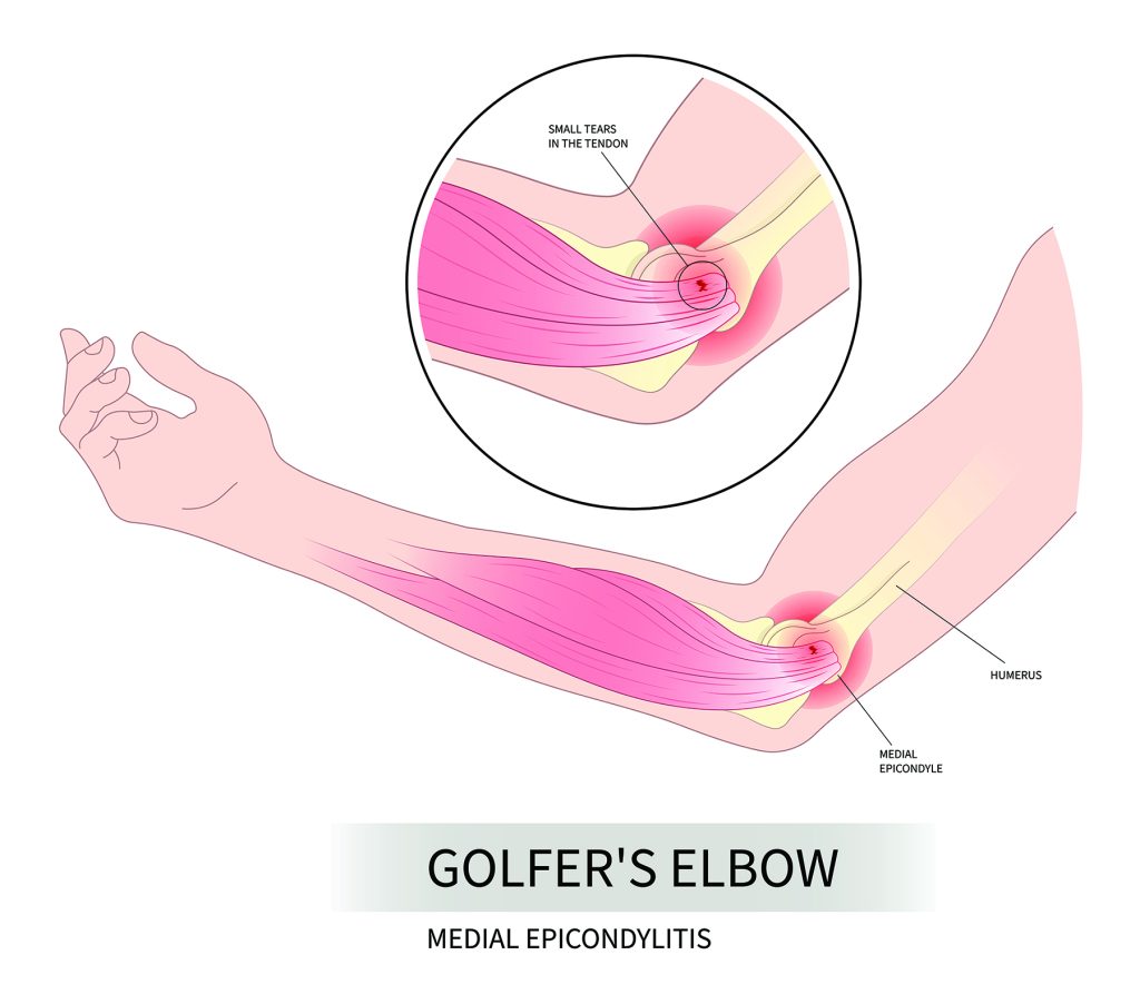 Diagram showing bones, muscles and ligaments in the elbow and arm that are affected by golfer's elbow.