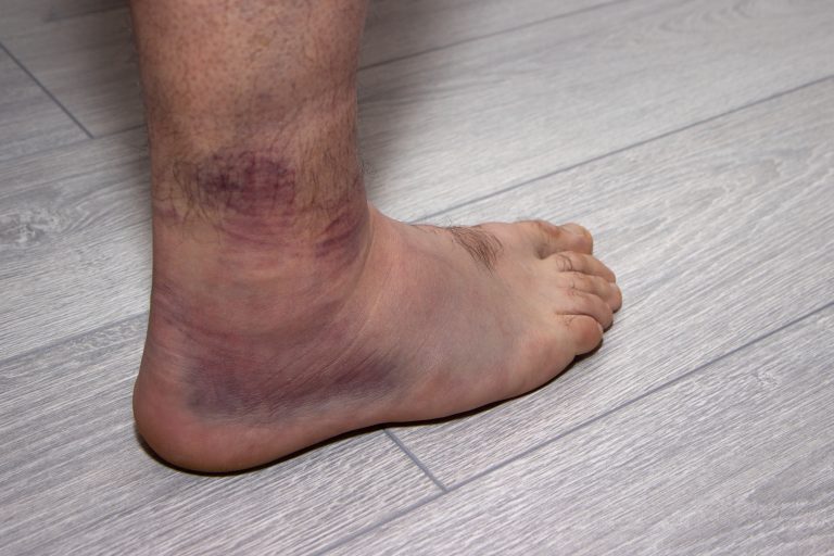 ankle-sprain-nhs-inform