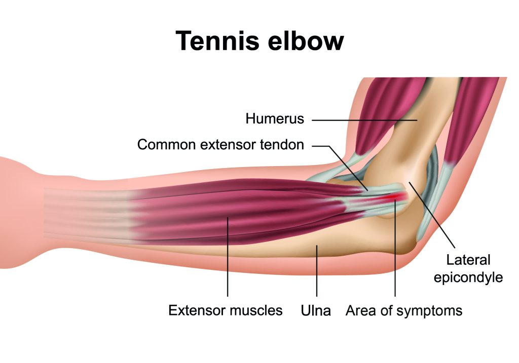 Diagram showing areas of the arm and elbow including bones, muscles and ligaments that are affected by tennis elbow.