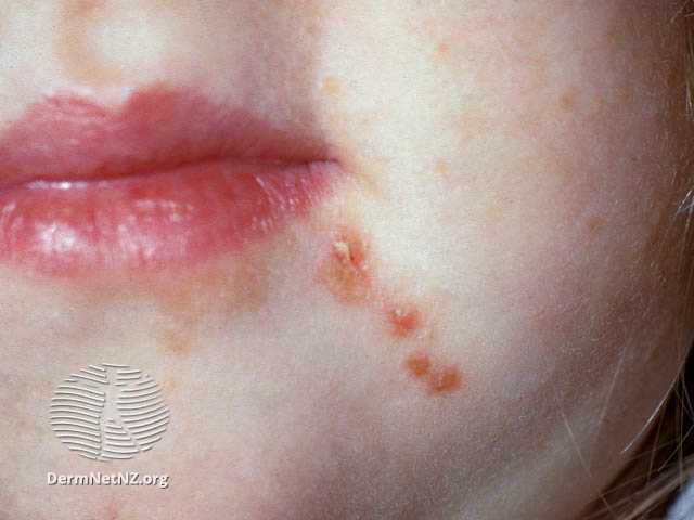 Small, dark pink patches on child's chin.